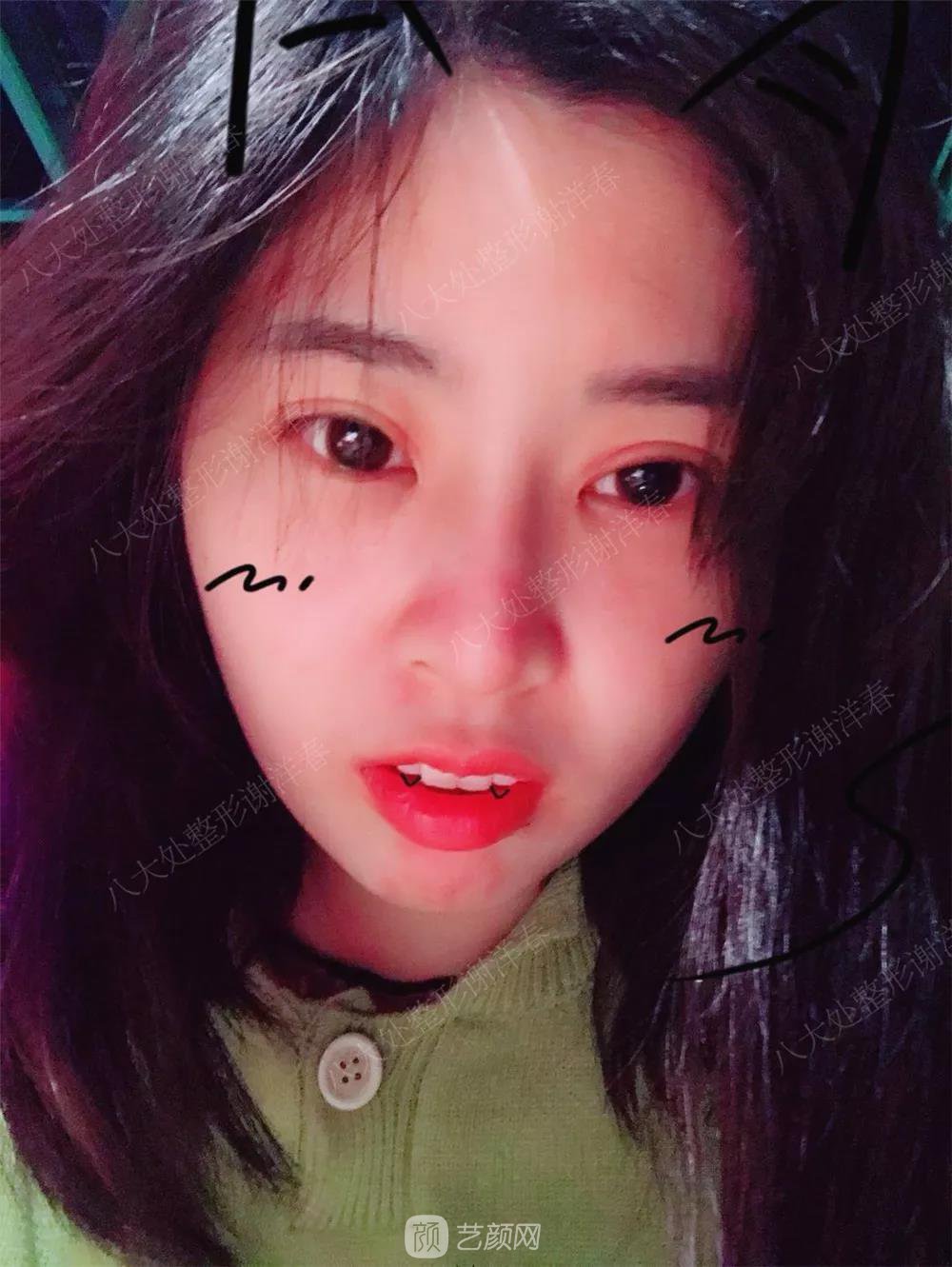 北京八大處割雙眼皮恢復(fù)過(guò)程，內(nèi)附圖