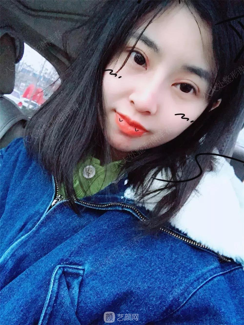 北京八大處割雙眼皮恢復(fù)過(guò)程，內(nèi)附圖