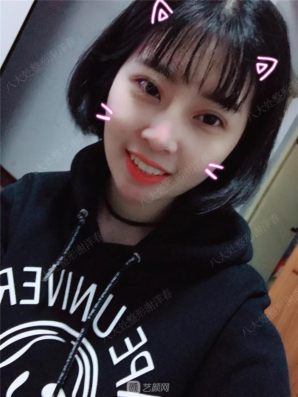 北京八大處割雙眼皮恢復(fù)過(guò)程，內(nèi)附圖