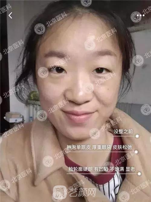 北京八大處整形布仁全切雙眼皮真實案例|圖