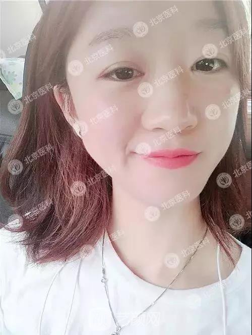 北京八大處整形布仁全切雙眼皮真實案例|圖