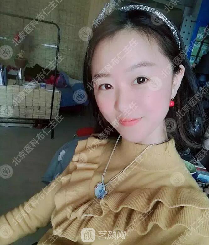 北京八大處整形布仁全切雙眼皮真實案例|圖
