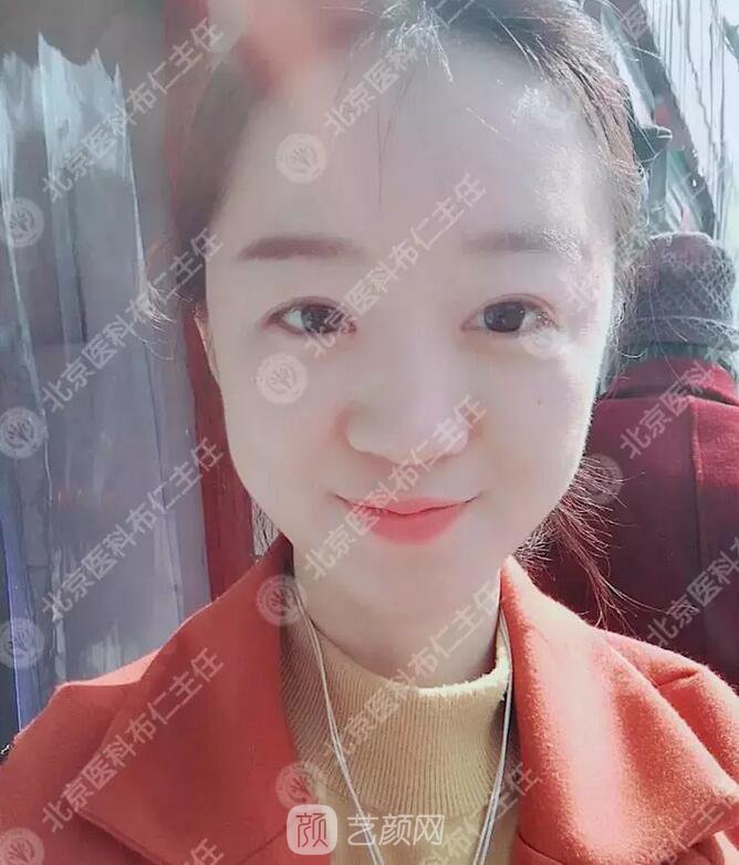 北京八大處整形布仁全切雙眼皮真實案例|圖