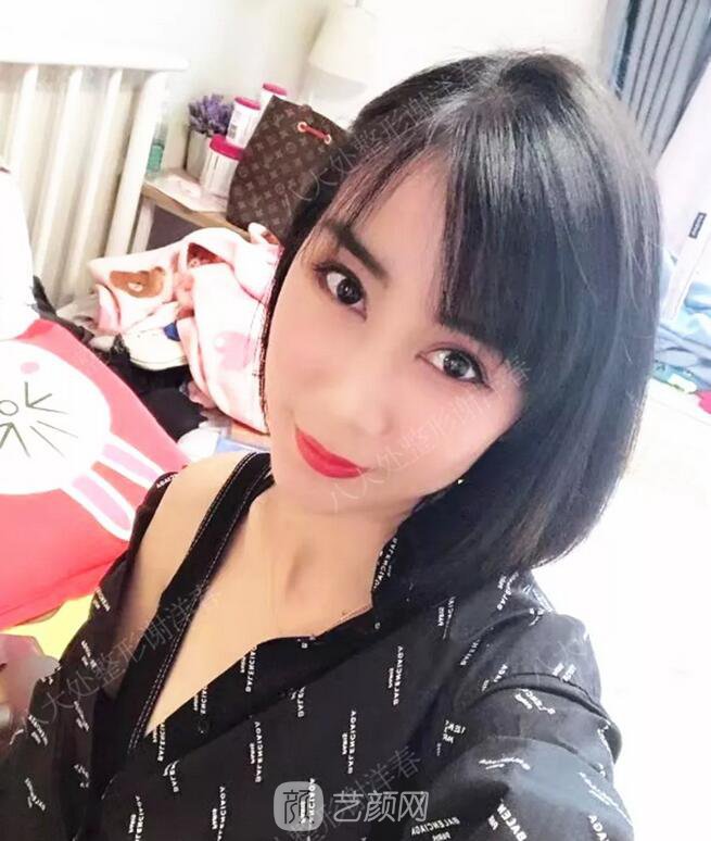 北京八大處面部脂肪填充心形臉真實(shí)案例|照片