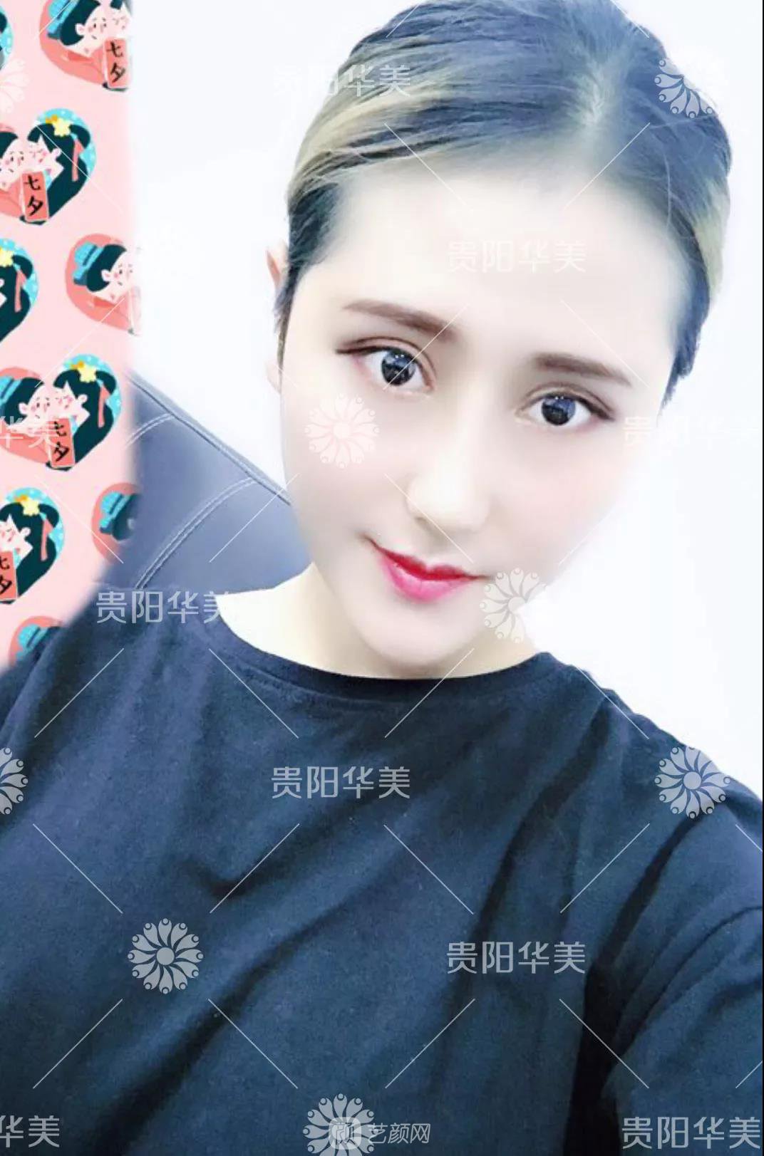 貴陽華美謝占軍割雙眼皮+隆鼻真人案例圖分享