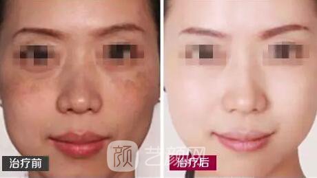 激光祛斑果怎么樣，會上皮膚嘛，怎么才能成功祛斑
