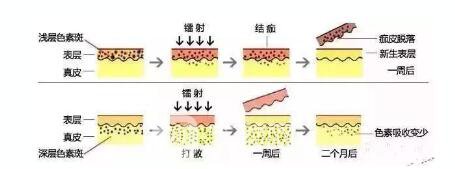 激光祛斑果怎么樣，會上皮膚嘛，怎么才能成功祛斑