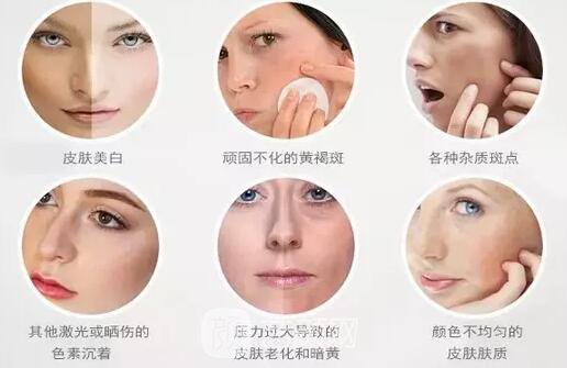 激光祛斑果怎么樣，會上皮膚嘛，怎么才能成功祛斑