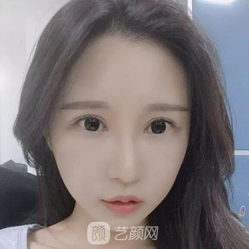 成都銅雀臺(tái)雷剛雙眼皮修復(fù)案例分享，半個(gè)月果圖~