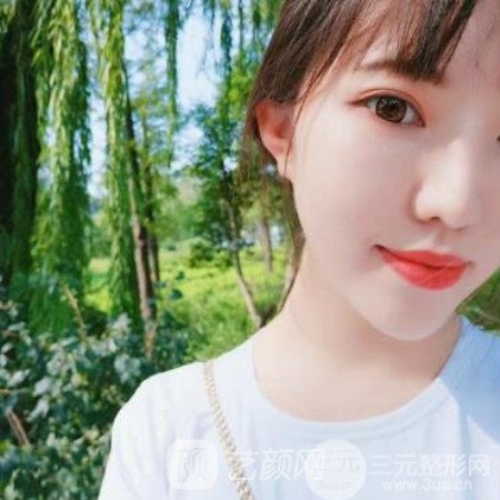 四川省人民醫(yī)院傅榮開(kāi)內(nèi)眼角+割雙眼皮三個(gè)月果分享~