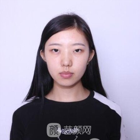 四川省人民醫(yī)院傅榮開(kāi)內(nèi)眼角+割雙眼皮三個(gè)月果分享~