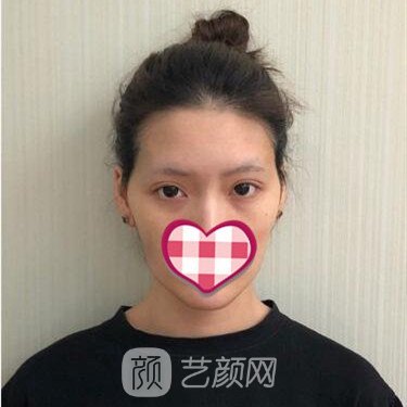 重慶鵬愛(ài)李晨耕自體脂肪面部填充一個(gè)月案例分享~