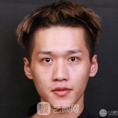 重慶軍美胡金香鼻部手術(shù)六個(gè)月了，分享恢復(fù)果~