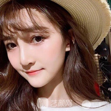 武漢華亞李?lèi)?ài)林自體脂肪面部填充三個(gè)月案例分享~