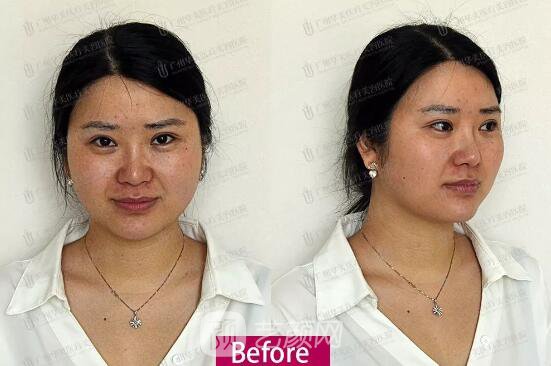 皮-秒激光祛斑案例，恢復照片分享~