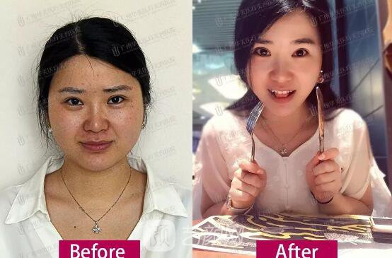 皮-秒激光祛斑案例，恢復照片分享~