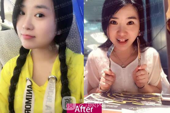 皮-秒激光祛斑案例，恢復照片分享~