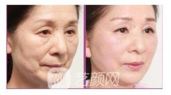 生物除皺價(jià)格多少?生物除皺價(jià)格影響因素~