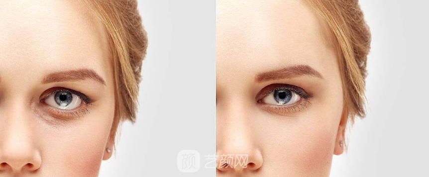 激光祛眼袋價(jià)格貴嗎？大概需要多少錢？