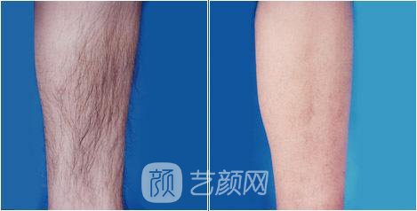 溫州激光脫毛一般要多少錢？