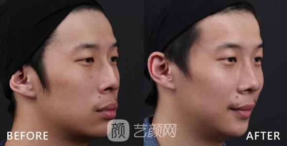 武漢駝峰鼻矯正費(fèi)用大概多少?