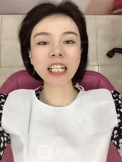 真實齙牙矯正牙齒案例