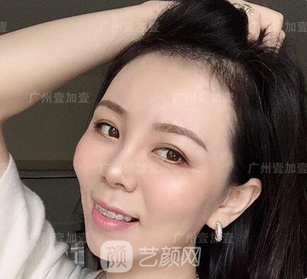 真實齙牙矯正牙齒案例