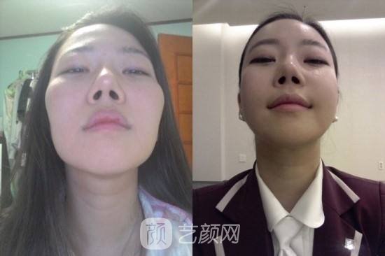 上海顴骨手術(shù)多少錢(qián)?