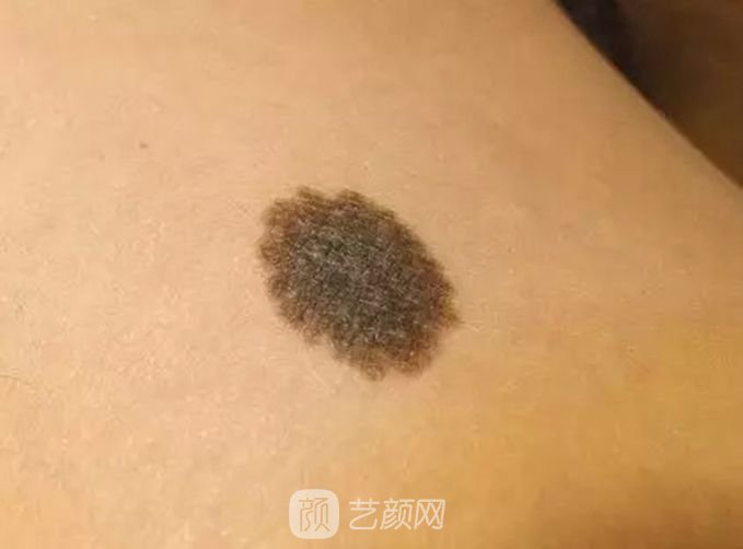 北京激光去痦子多少錢？