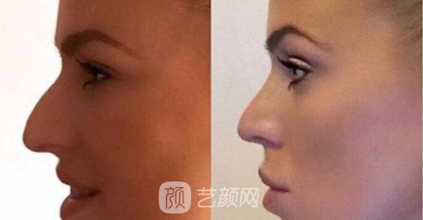 北京自體肋軟骨隆鼻費用是多少