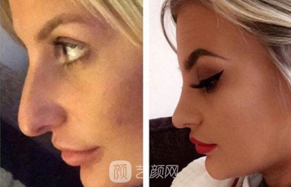 北京自體肋軟骨隆鼻費用是多少