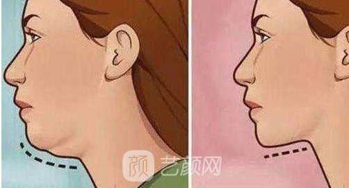 深圳磨尖下巴骨多少錢？