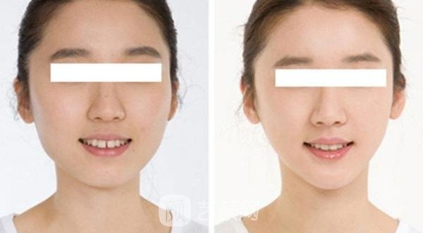 【上海顴骨磨骨手術(shù)多少錢(qián)？】