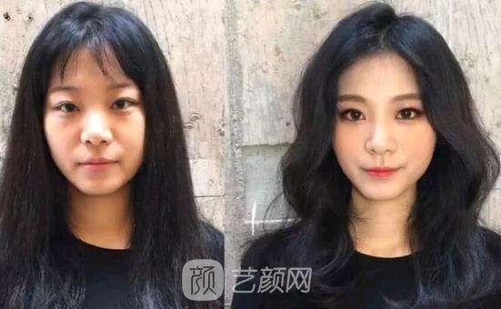 【上海顴骨磨骨手術(shù)多少錢(qián)？】