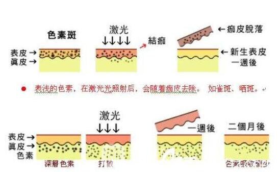 光子嫩膚去毛孔和黑頭