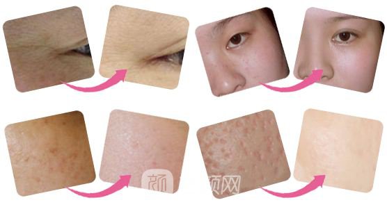 唐山做全身光子嫩膚價格大概多少錢？