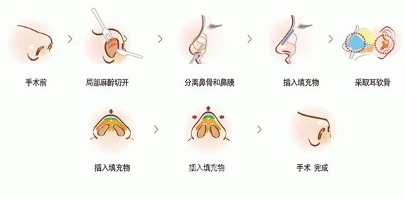 上海耳軟骨墊鼻尖多少錢?