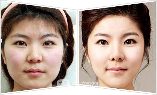 成都面部吸脂瘦臉多少錢?