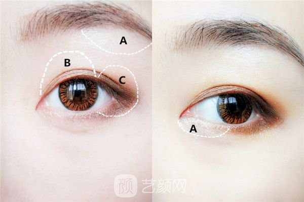 自體脂肪填充眼窩多少錢?