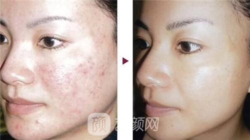 上海像素激光祛痘價格?