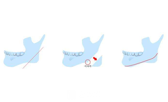 北京專業(yè)磨下頜角整形醫(yī)院有哪些