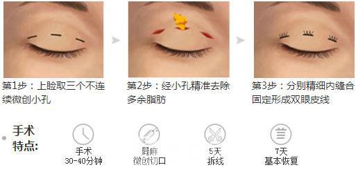 上海韓式三點(diǎn)雙眼皮價(jià)格多少?