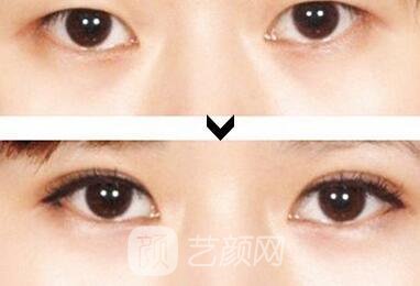 上海韓式三點(diǎn)雙眼皮價(jià)格多少?