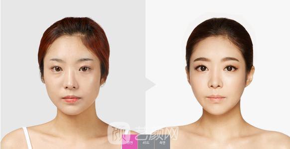 潤(rùn)百顏玻尿酸價(jià)格是多少？