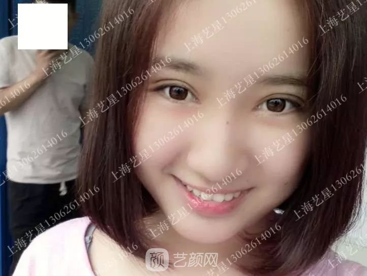 上海藝星割雙眼皮術(shù)后一個月恢復(fù)日記一則~