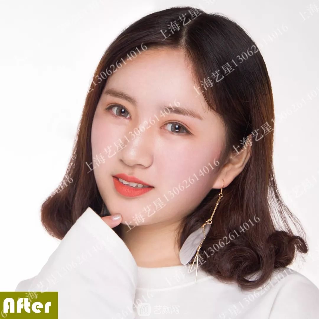 上海藝星割雙眼皮術(shù)后一個月恢復(fù)日記一則~