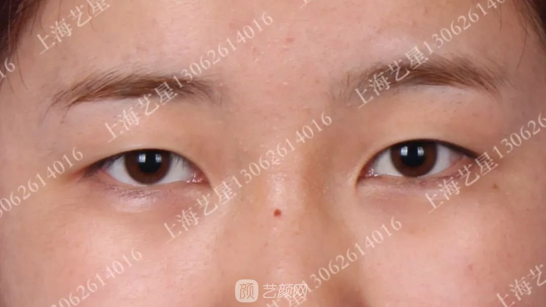 上海藝星割雙眼皮術(shù)后一個月恢復(fù)日記一則~