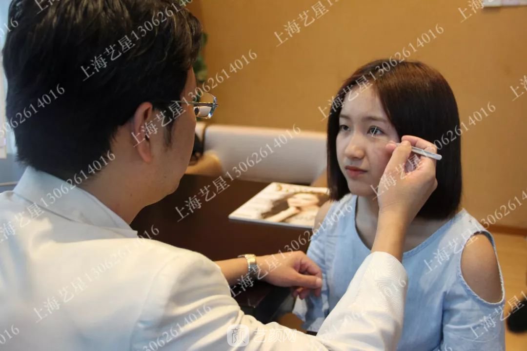 上海藝星割雙眼皮術(shù)后一個月恢復(fù)日記一則~