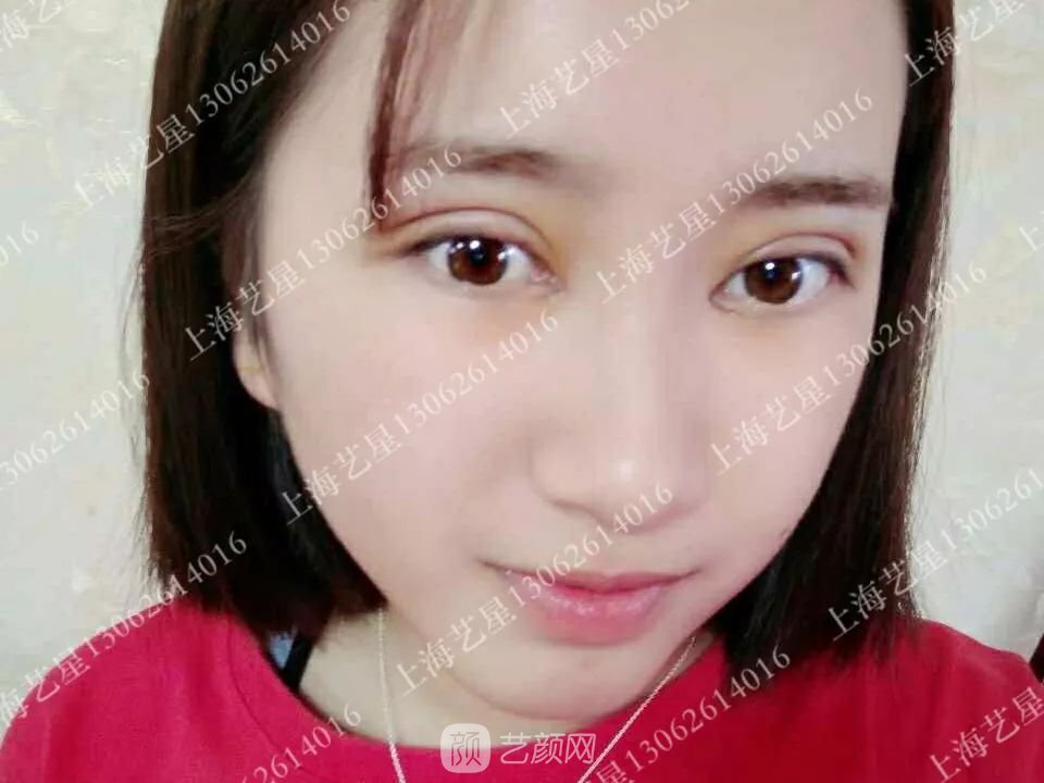 上海藝星割雙眼皮術(shù)后一個月恢復(fù)日記一則~