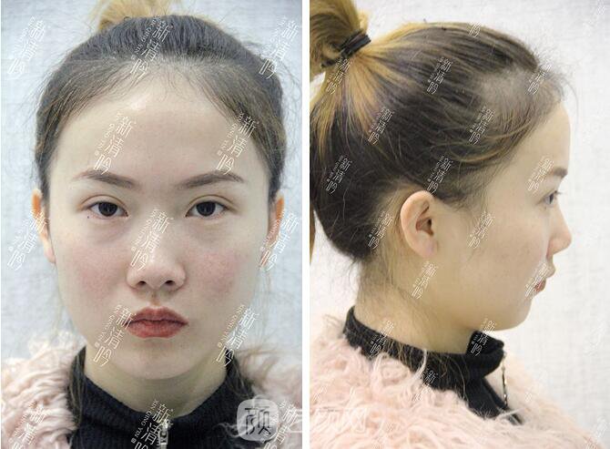 耳軟骨隆鼻果圖分享，術(shù)后~